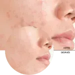 ly_salicylic_acid_2_7_before-after_1738257515_1024x1024