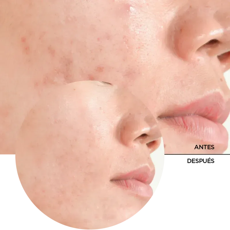 ly_salicylic_acid_2_7_before-after_1738257515_1024x1024