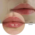 ly_lip_filler_7_before-after_1738232077_1024x1024
