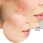 ly_zitcare_face_toner_7_before-after_1738692348_1024x1024