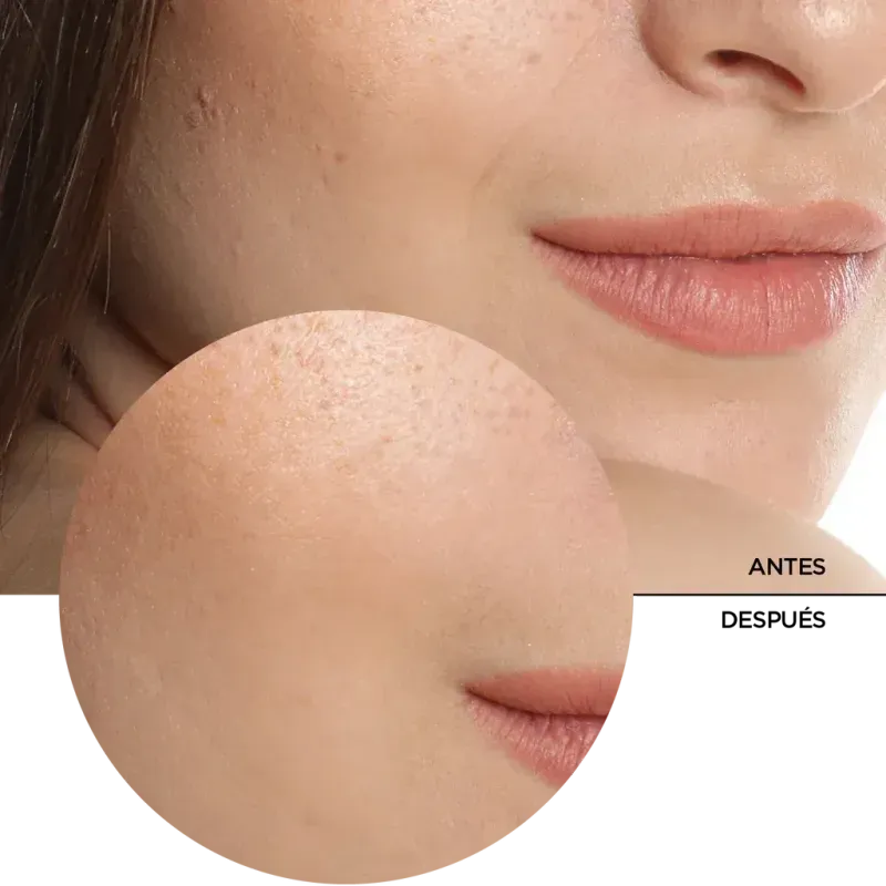 ly_hyaluronic_acid_5_7_before-after_1738232732_1024x1024